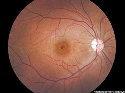 Macular hole caused by viewing a solar eclipse