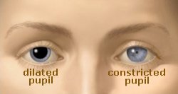 Dilated pupil and constricted pupil