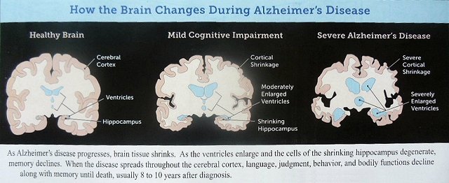 alzheimer's/Alzheimer's Disease.jpg
