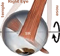 Right Superior Rectus Muscle