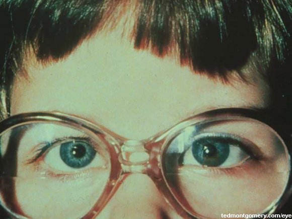 Accommodative Esotropia: Corrected