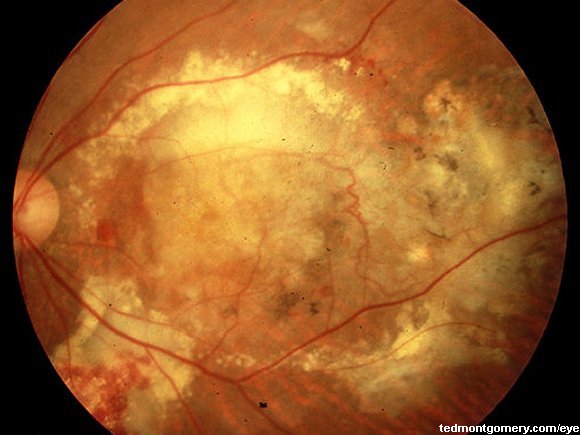 Age-Related Macular Degeneration: #4