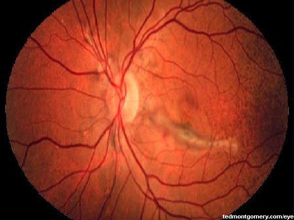Angioid Streak