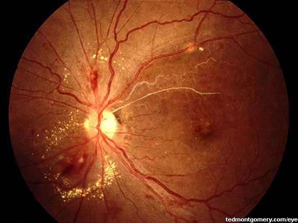 Aoritis