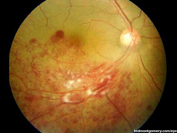 Branch Retinal Vein Occlusion: #2