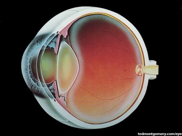 Cataract