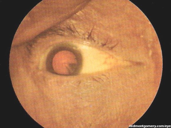 Cortical Cataract