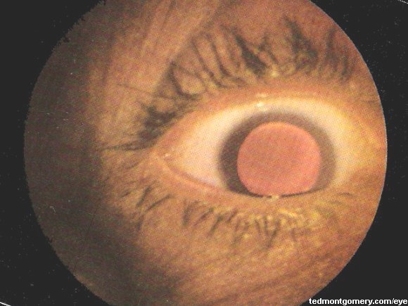 Nuclear Sclerotic Cataract