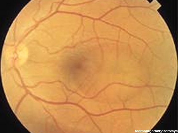 Central Serous Chorioretinopathy: #2