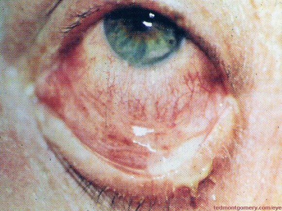 Bacterial Conjunctivitis: #1
