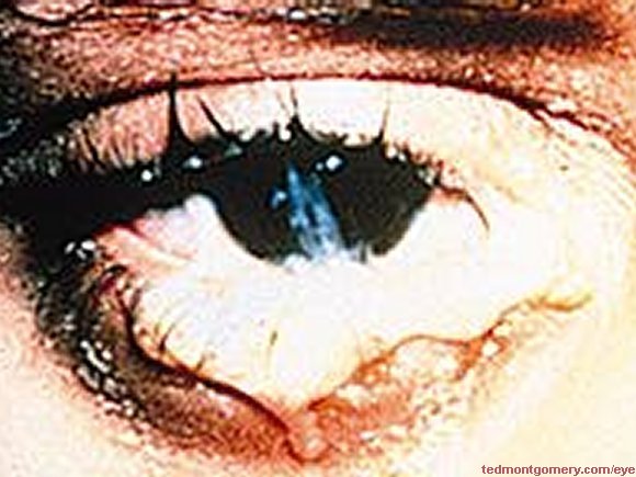 Conjunctivitis, Chlamydial/Gonococcal