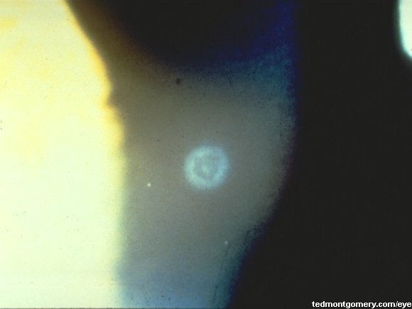 Corneal Bacterial Ulcer: #2