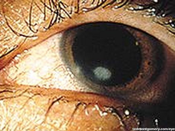 Corneal Bacterial Ulcer: #3