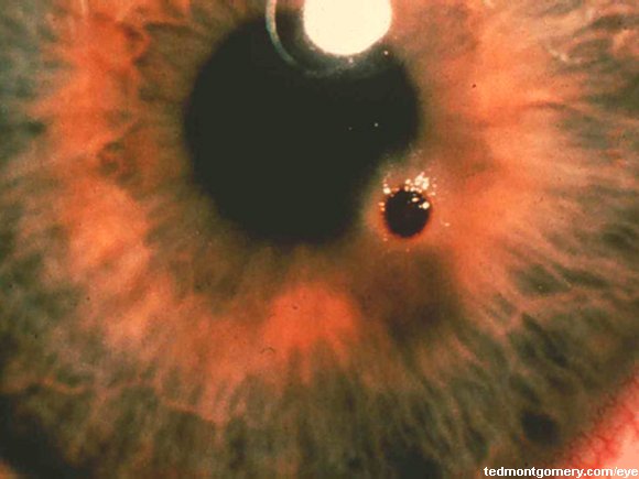Corneal Foreign Body: #1
