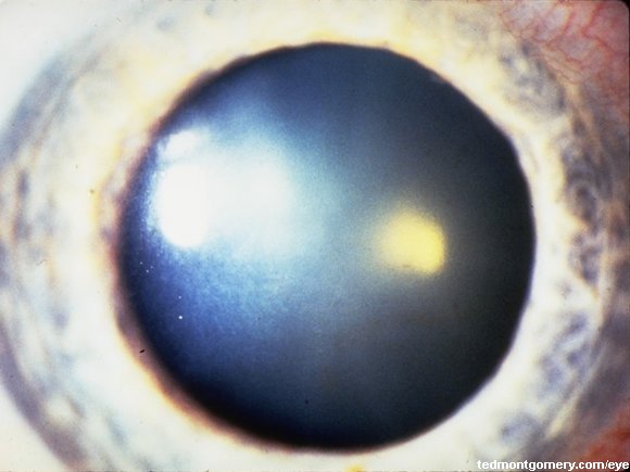 Corneal Fuchs Dystrophy