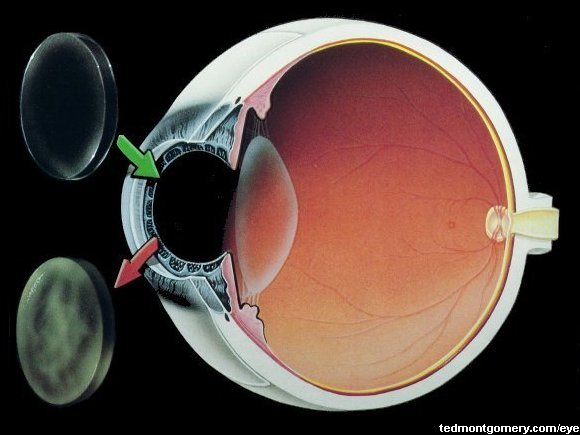 Corneal Transplant