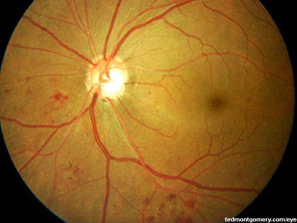 Diabetic Retinopathy: #3