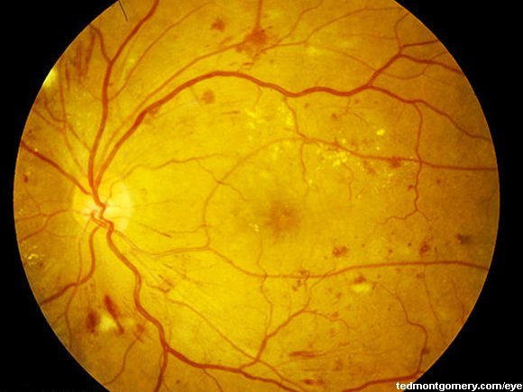 Diabetic Retinopathy: #4