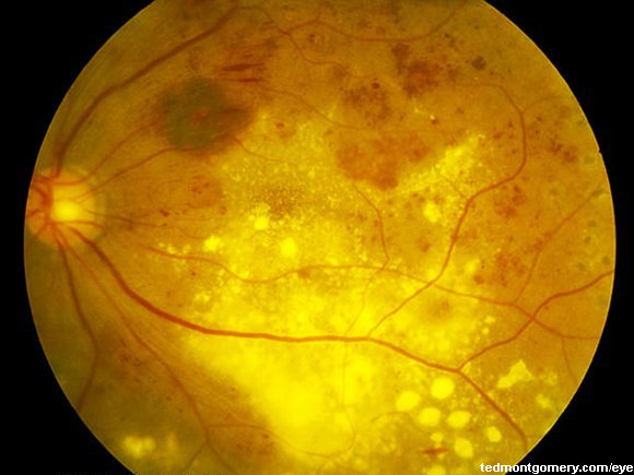 Diabetic Retinopathy: #5