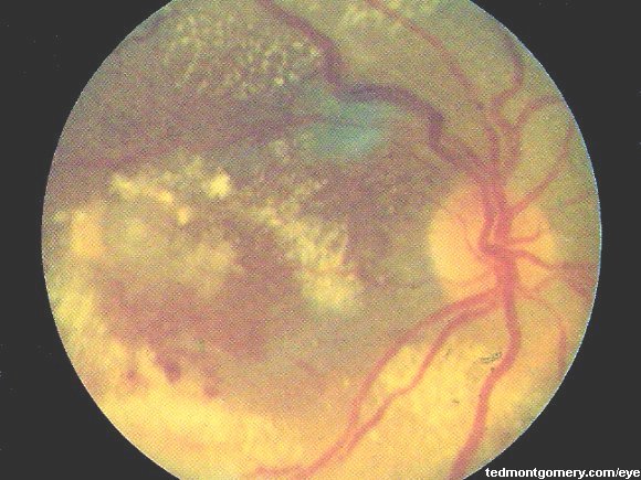 Diabetic Retinopathy: #7