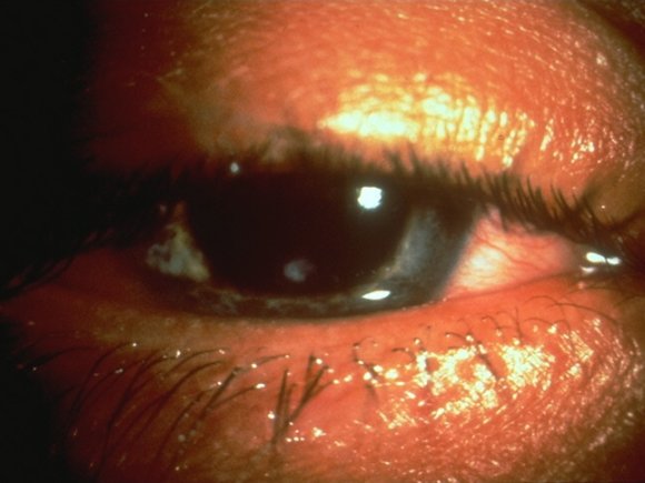 Edematous Eyelids