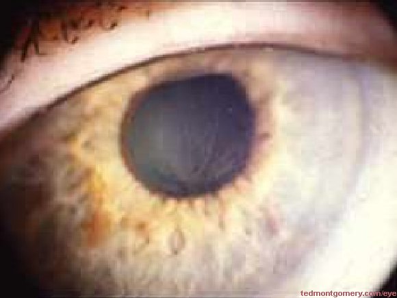 Fabry's Keratopathy