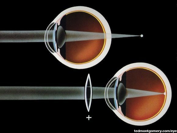 Farsightedness (Hyperopia)