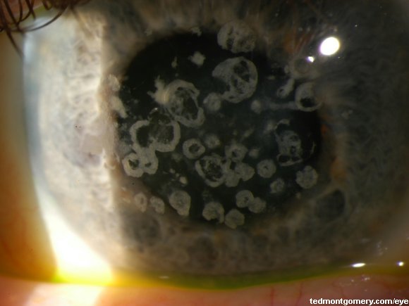 Granular Dystrophy