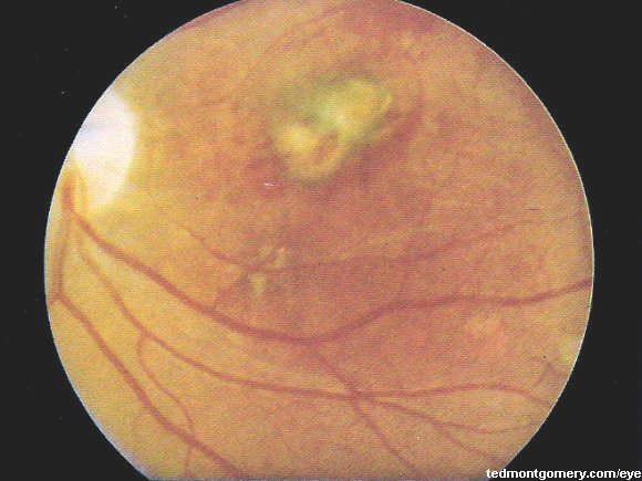 Histoplasmosis Chorioretinitis