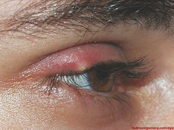 External Hordeolum (Stye)