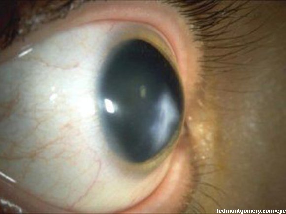 Keratoconus