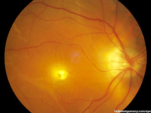 Macular Hole: #1