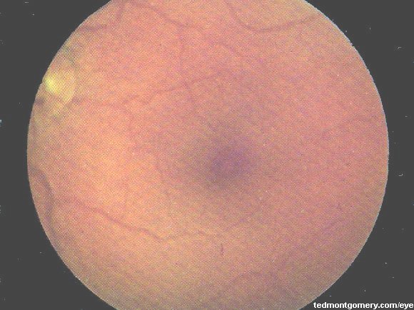 Macular Hole: #2