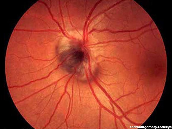 Melanocytoma: #1
