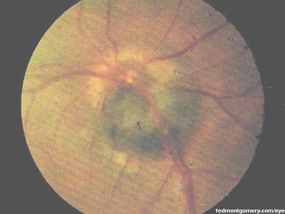 Melanocytoma: #2