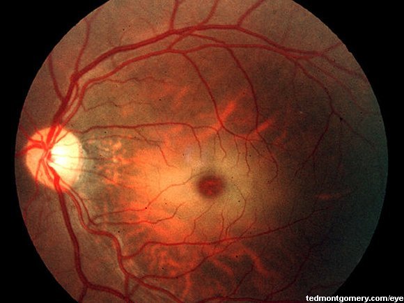 Mucolipidosis