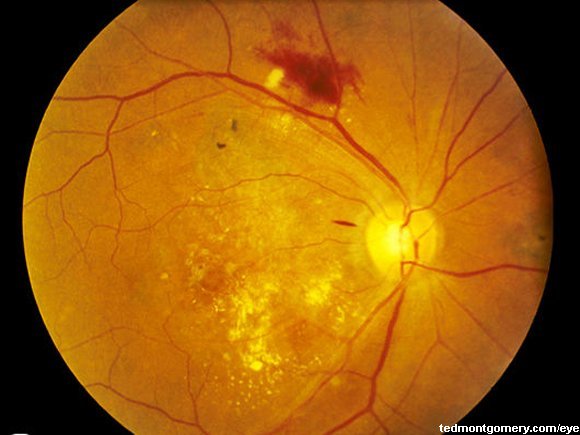 Nephritis