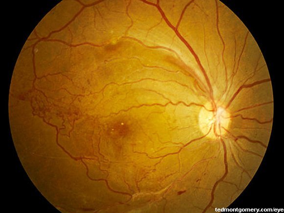Nerve Fiber Defect + Branch Vein Occlusion