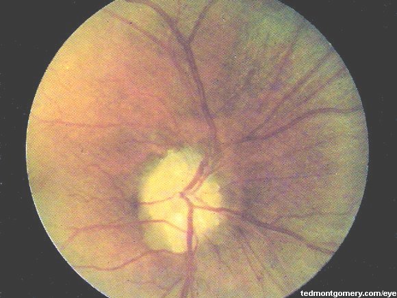 Optic Nerve Head Drusen