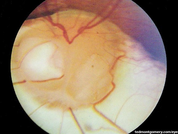Optic Nerve Coloboma