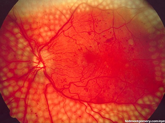 Retinal Photos