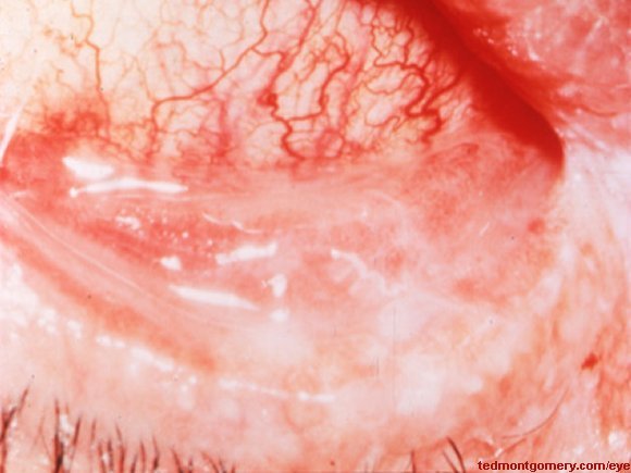 Pemphigoid