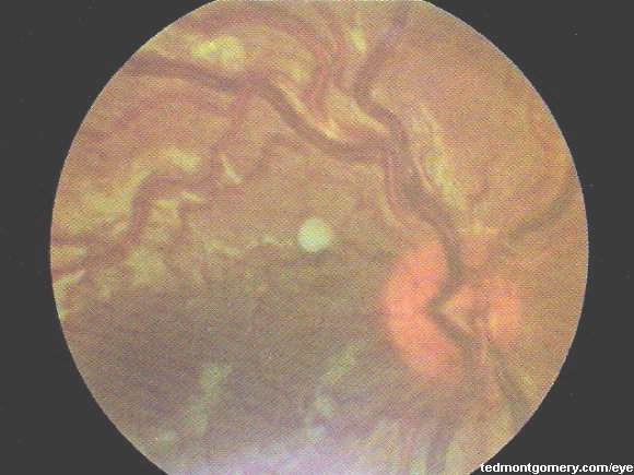 Polycythemia