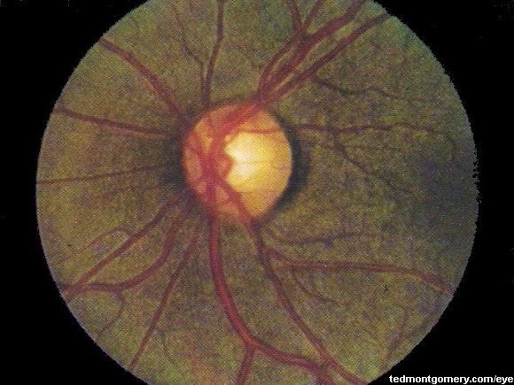 Normal Retina (Asian)