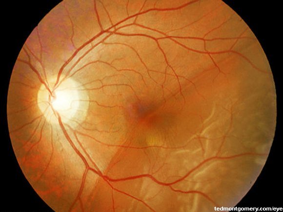 Retinal Detachment: #2