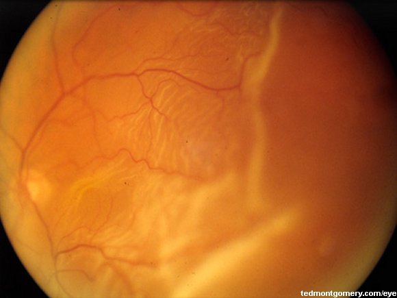 Retinal Detachment: #3