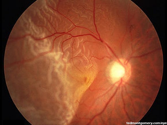 Retinal Detachment: #4