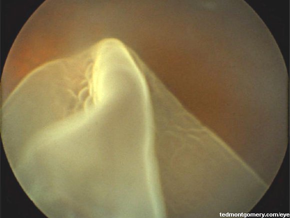 Retinal Tear: #1