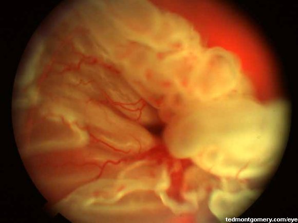 Retinal Tear: #4