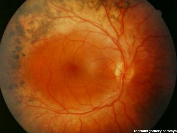 Retinitis Pigmentosa: #1